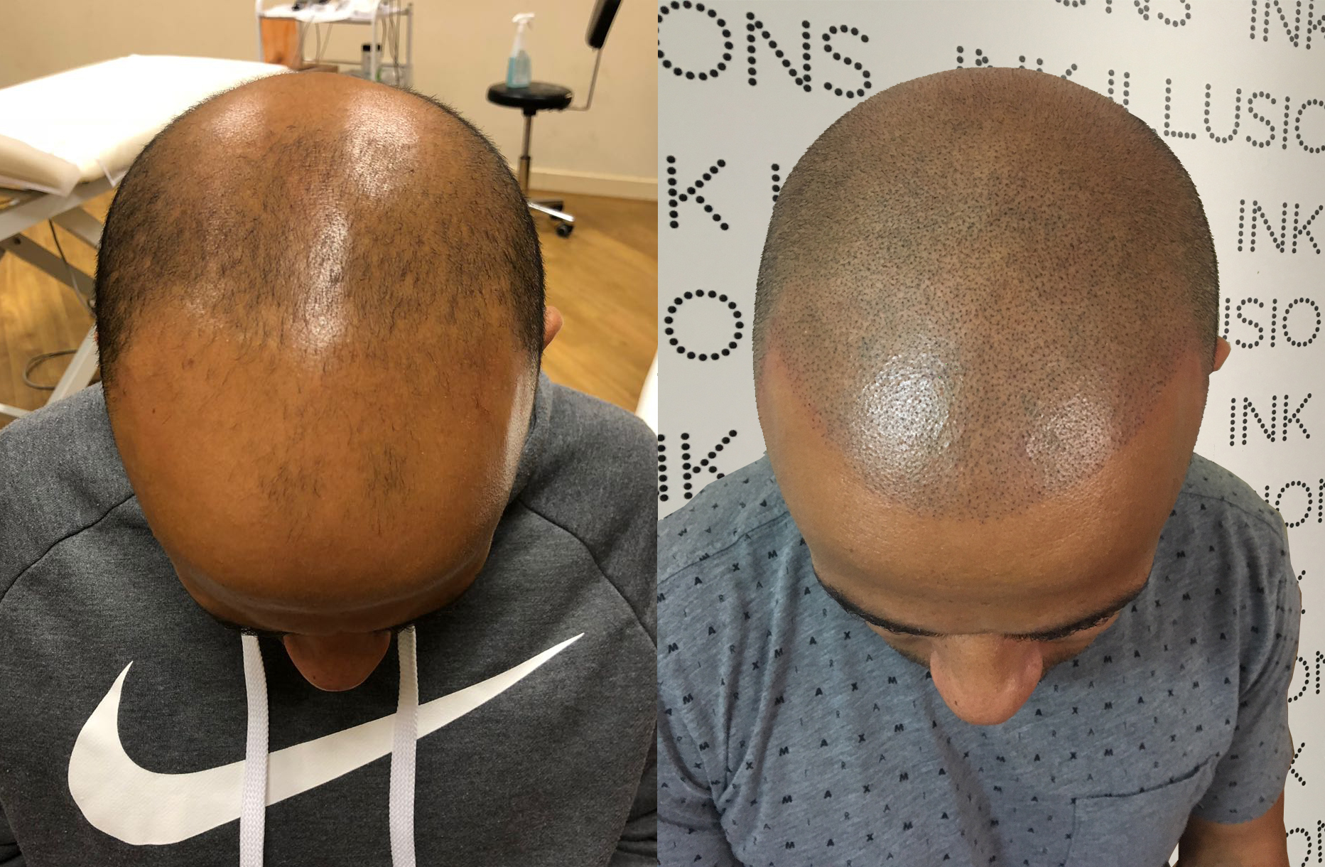 Scalp Micropigmentation Treatment